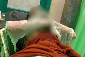 Perempuan Dibakar Mantan Suami Di Kobar, Korban Alami Luka Bakar Serius